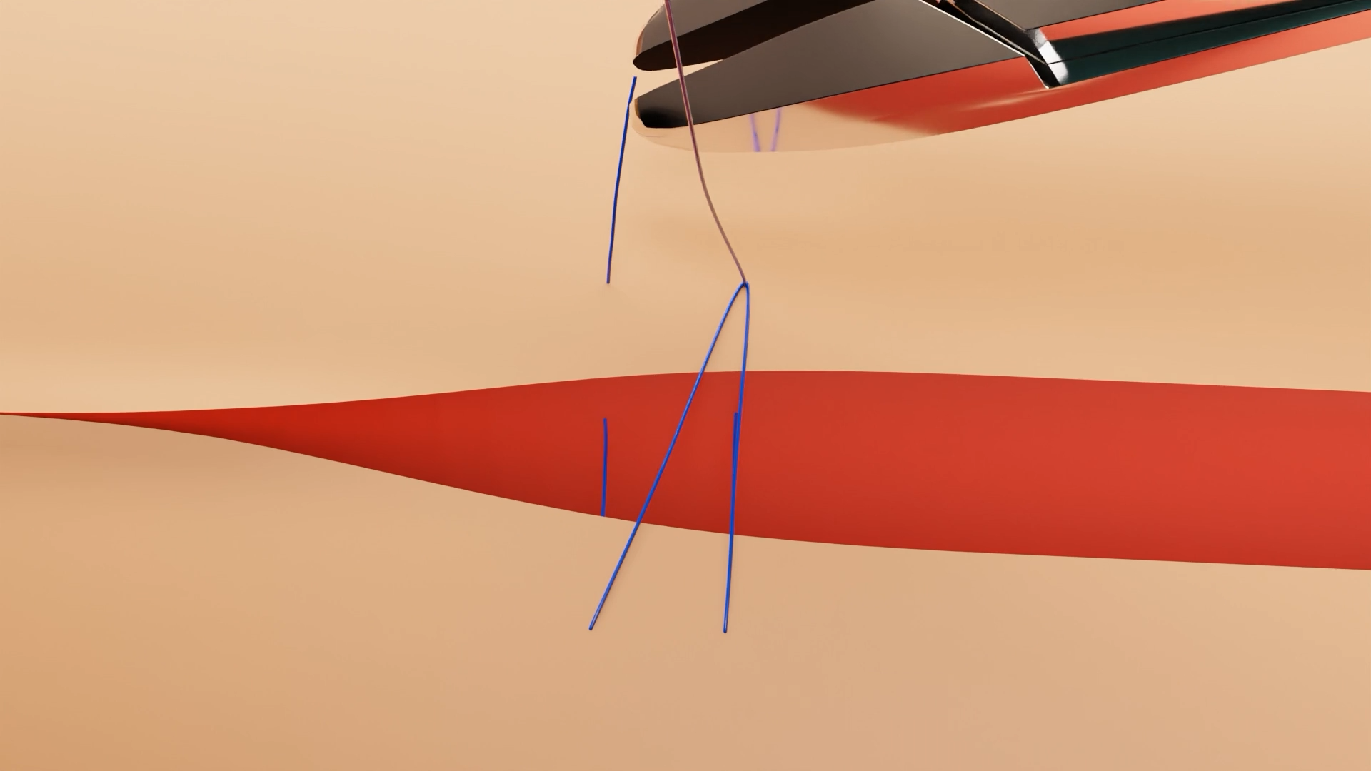 Horizontal Mattress Pulley Suture