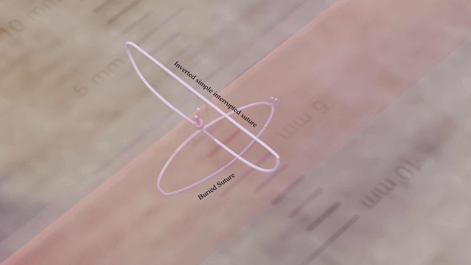 Simple Buried Suture