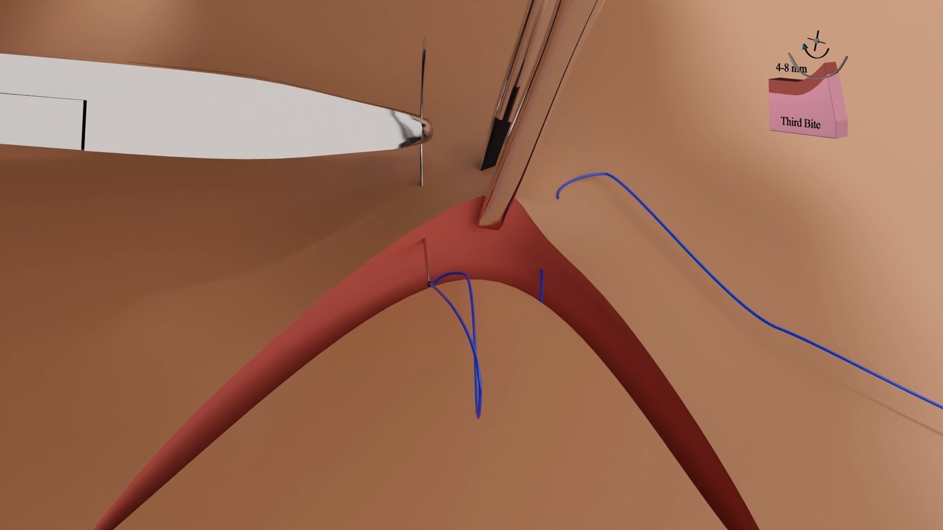 Half Buried Horizontal Mattress Suture