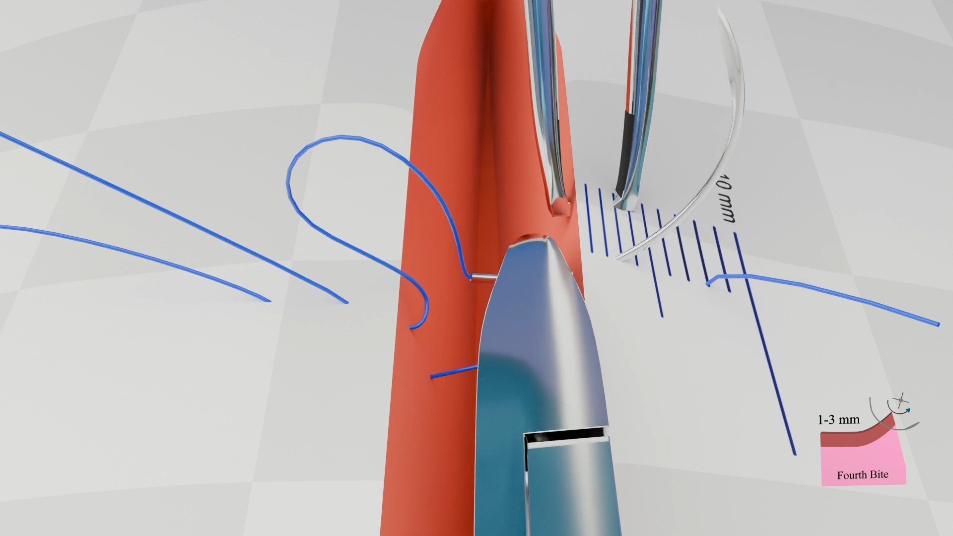 Vertical Mattress Suture