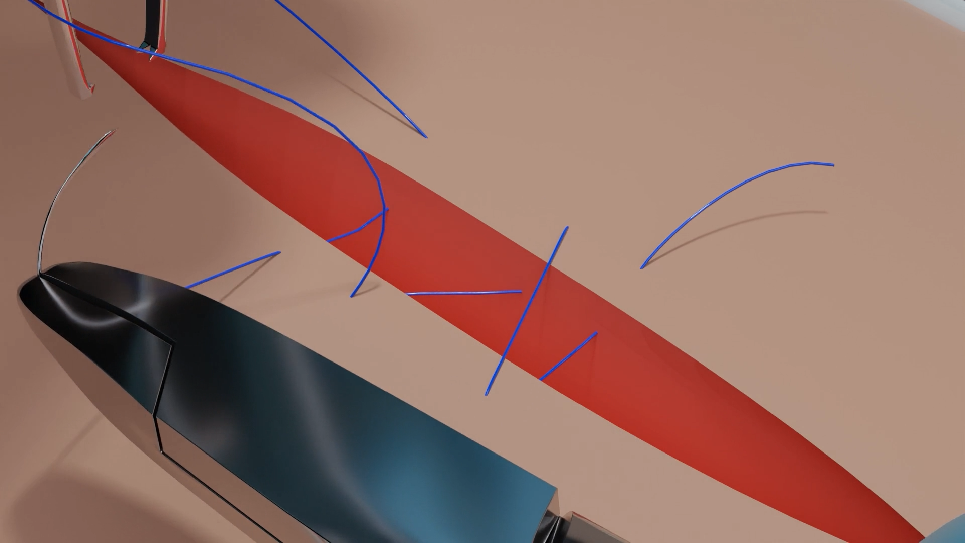 Winch Suture