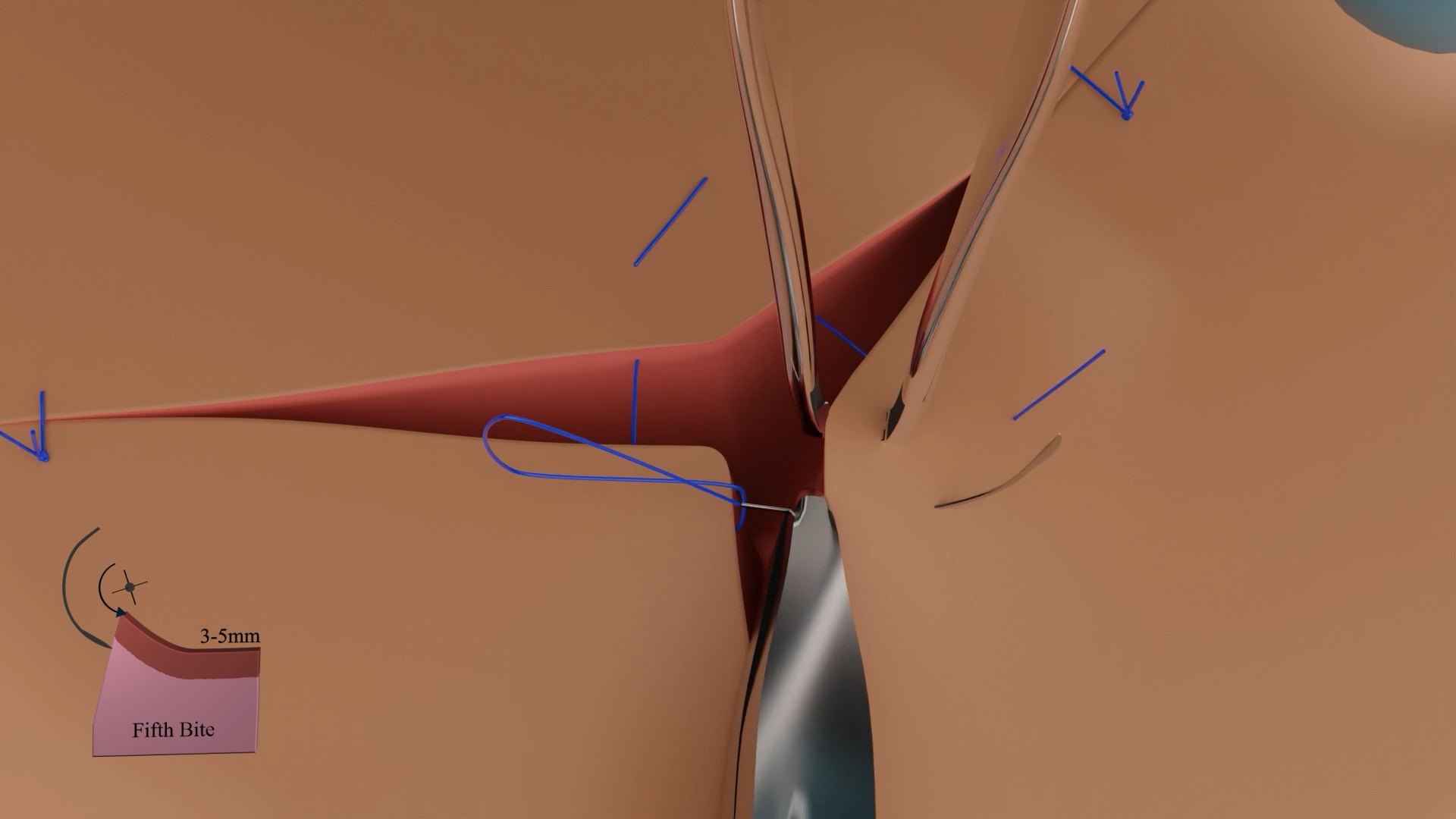 Hybrid Mattress Suture